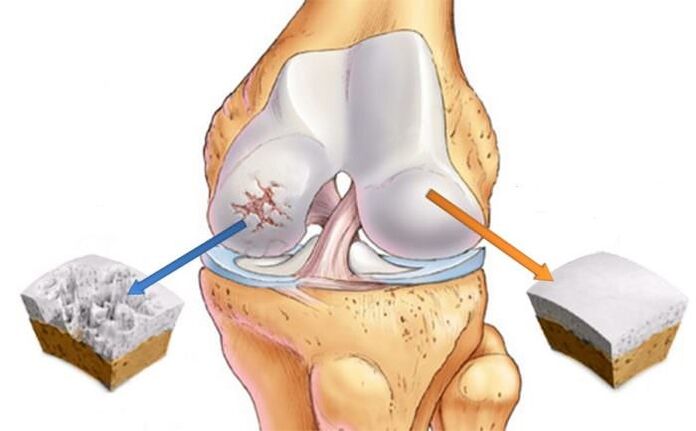 Was ist Arthrose
