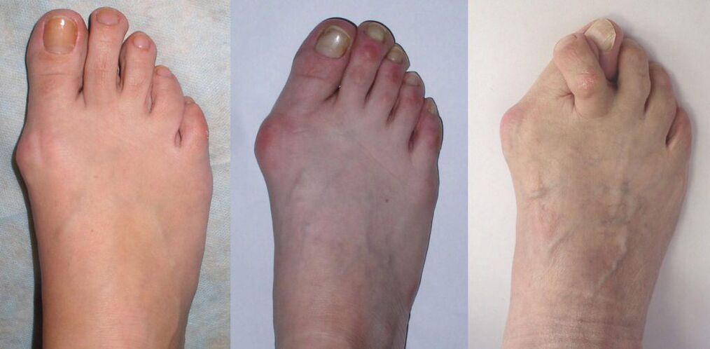 Arthritis des Fußes