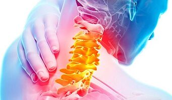 Anzeichen einer Osteochondrose der Halswirbelsäule