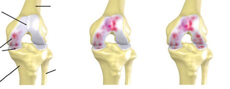 Grad der Arthrose