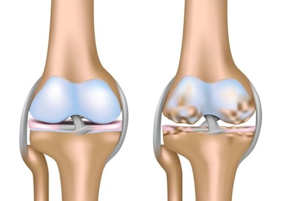 Was ist Gonarthrose