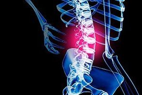 Osteochondrose der Lendenwirbelsäule