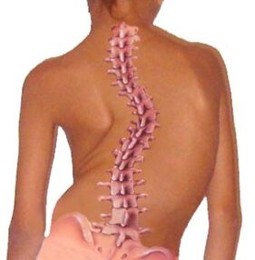 Eine Krümmung der Wirbelsäule führt zu Osteochondrose