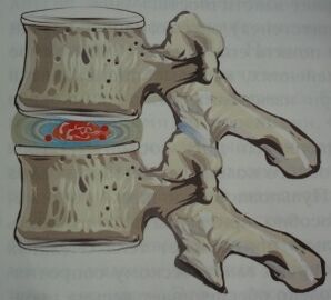 Erstes Stadium der Osteochondrose